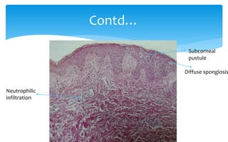 Contd…
Subcorneal
pustule
Diffuse spongiosis
Neutrophilic
infiltration
 