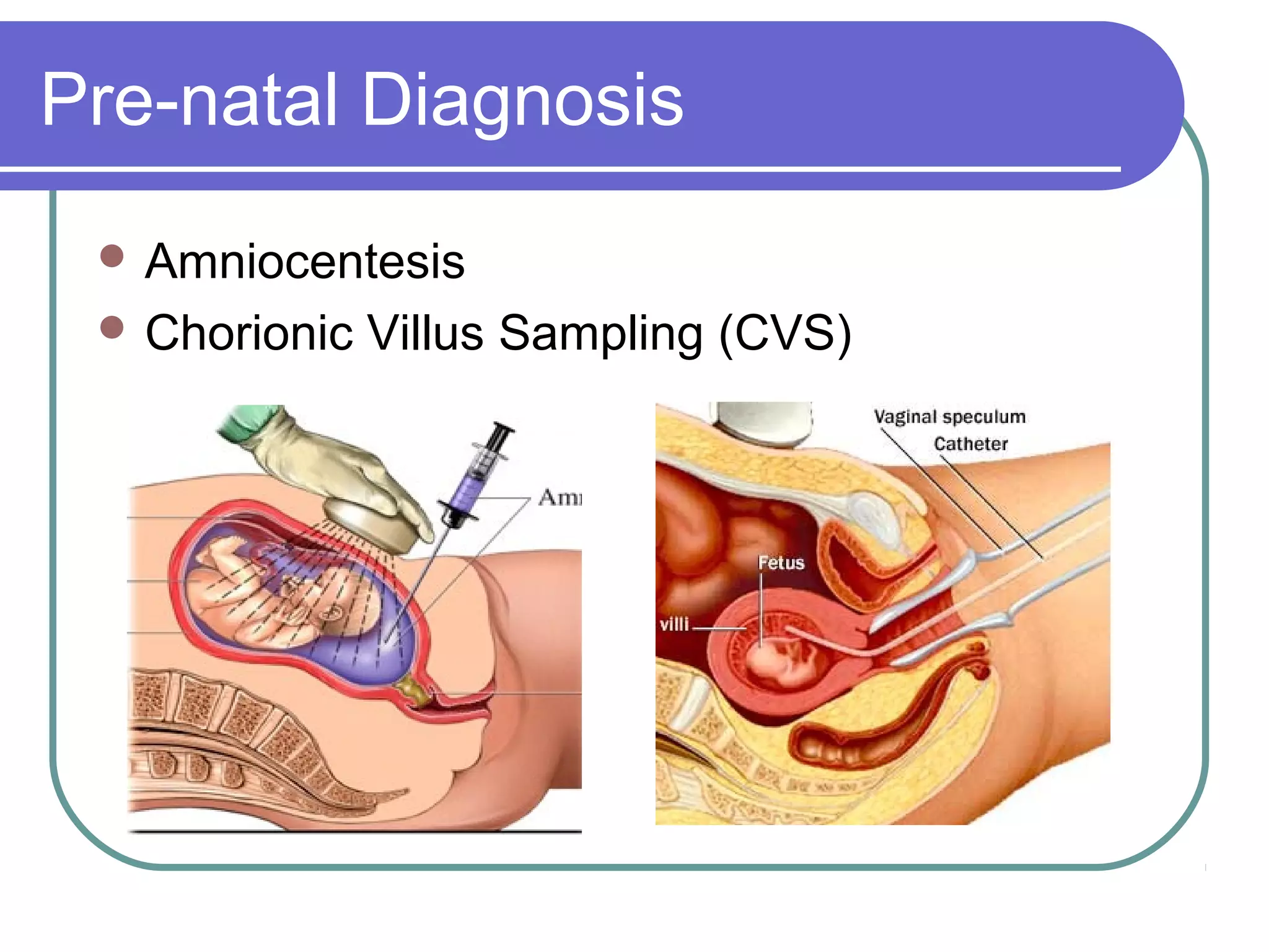 Pre-natal Diagnosis
Amniocentesis
Chorionic Villus Sampling (CVS)