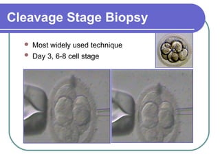 Cleavage Stage Biopsy 
 Most widely used technique 
 Day 3, 6-8 cell stage 
 