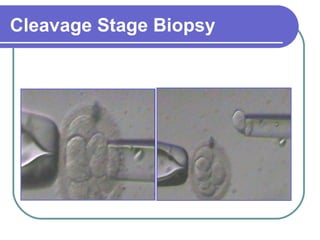 Cleavage Stage Biopsy 
 