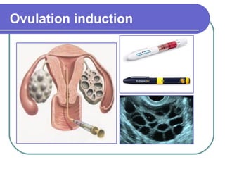 Ovulation induction 
 