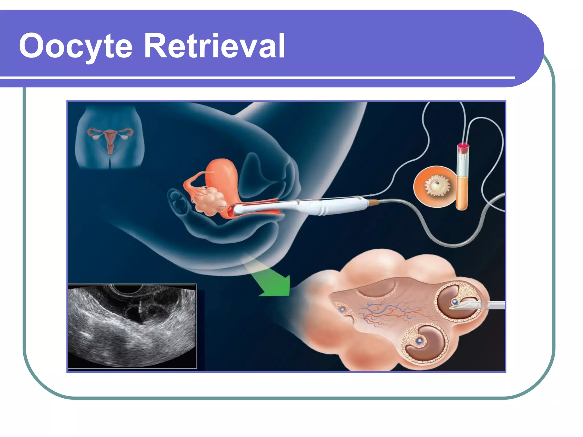 Oocyte Retrieval