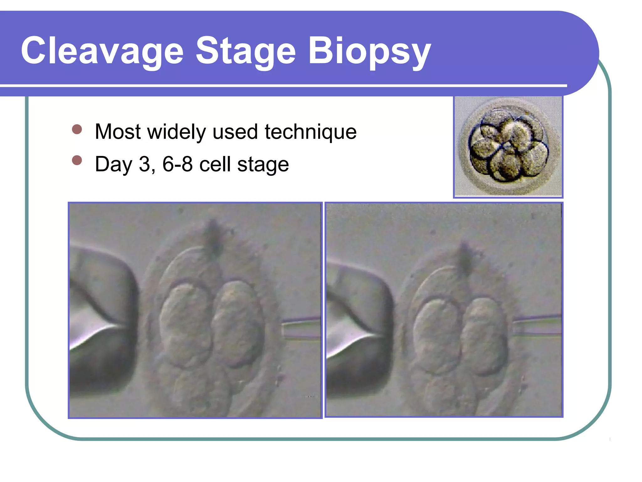 Cleavage Stage Biopsy
Most widely used technique
Day 3, 6-8 cell stage