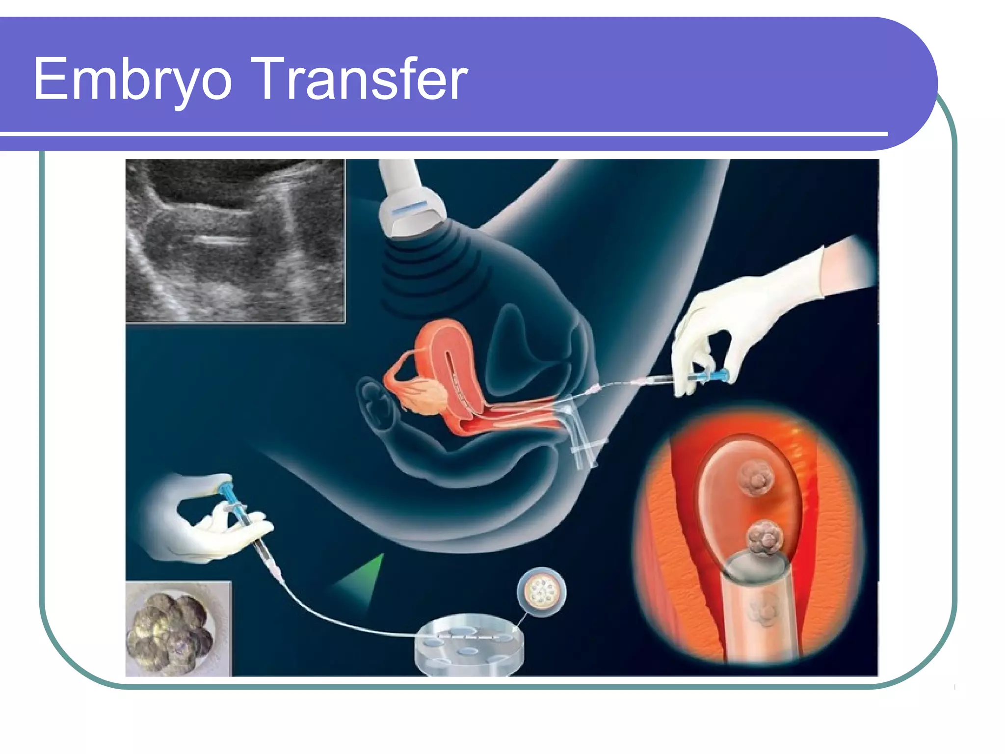 Embryo Transfer