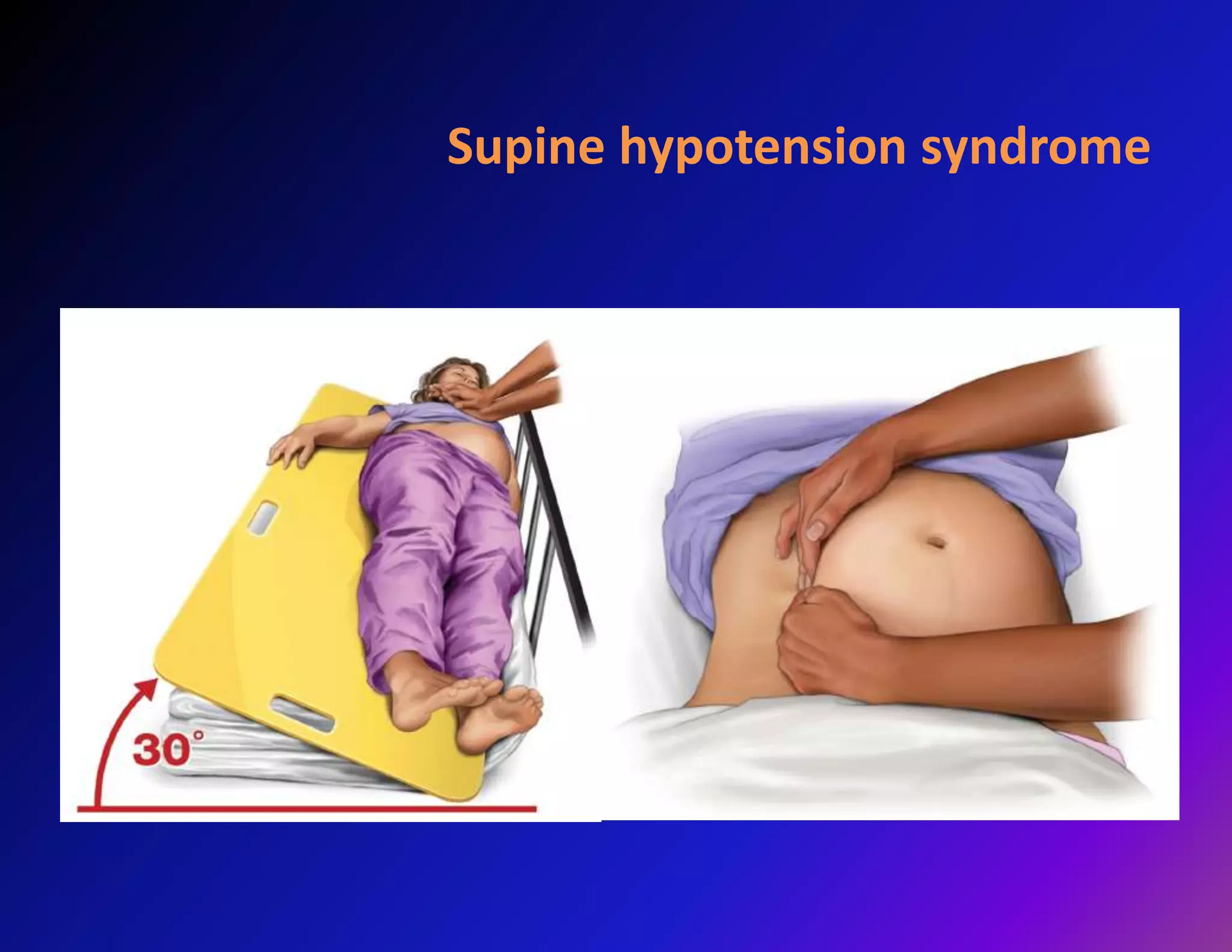 Supine hypotension syndrome 
 