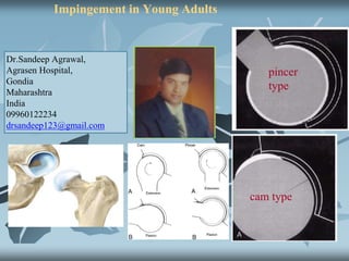 Treatment of Femoro-Acetabular Impingement in Young
Adults
cam type
pincer
type
Dr.Sandeep Agrawal,
Agrasen Hospital,
Gondia
Maharashtra
India
09960122234
drsandeep123@gmail.com
 