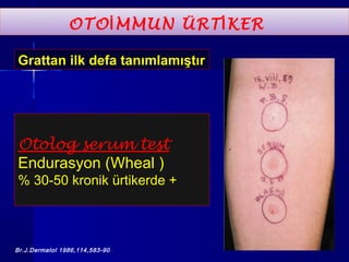 OTOİMMUN ÜRTİKER 
Grattan ilk defa tanımlamıştır 
Otolog serum test 
Endurasyon (Wheal ) 
% 30-50 kronik ürtikerde + 
Br.J.Dermatol 1986,114,583-90 
 