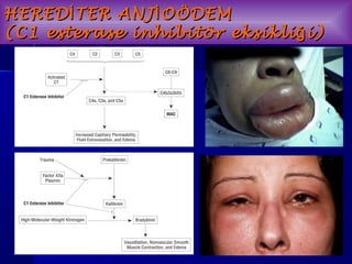 HHEERREEDDİİTTEERR AANNJJİİOOÖÖDDEEMM 
((CC11 eesstteerraassee iinnhhiibbiittöörr eekkssiikklliiğğii)) 
 