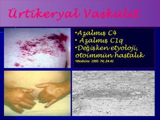 Ürtikeryal Vaskülit 
•Azalmış C4 
• Azalmış C1q 
•Değişken etyoloji, 
otoimmün hastalık 
•Medicine 1995 74; 24-41 
 