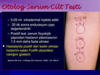 OOttoolloogg SSeerruumm CCiilltt TTeessttii 
– 00..0055 mmll iinnttrraaddeerrmmaall iinnjjeekkttee eeddiilliirr 
– 3300 ddkk ssoonnrraa eenndduurraassyyoonn ççaappıı 
ddeeğğeerrlleennddiirriilliirr 
– PPoossiittiiff tteesstt ;;sseerruumm ffiizzyyoolloojjiikk 
ççaappıınnddaann hhaassttaannıınn ppllaazzmmaassıınnıınn 
11..55 mmmm ddaahhaa ffaazzllaa oollmmaassıı 
 HHaassttaallaarrddaa ppoossiittiiff ddeerrii tteessttiinn oollmmaassıı 
hhiissttaammiinn--ssaallaann FFcceeRRII oottooaannttiikkoorr 
vvaarrllıığğıınnıı ggöösstteerriirr.. 
SSaabbrrooee RRAA eett aall.. JJ AAlllleerrggyy CClliinn IImmmmuunnooll 22000022;; 111100:: 449944--99 
 