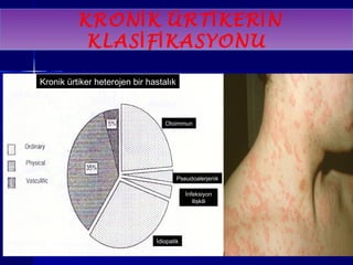 KRONİK ÜRTİKERİN 
KLASİFİKASYONU 
Kronik ürtiker heterojen bir hastalık 
Otoimmun 
Pseudoalerjenik 
İnfeksiyon 
ilişkili 
İdiopatik 
 