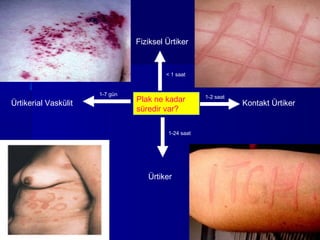 Fiziksel Ürtiker 
< 1 saat 
1-7 gün 1-2 saat 
Plak ne kadar 
süredir var? 
Ürtikerial Vaskülit Kontakt Ürtiker 
1-24 saat 
Ürtiker 
 