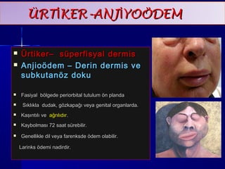 ÜÜRRTTİİKKEERR--AANNJJİİYYOOÖÖDDEEMM 
 ÜÜrrttiikkeerr–– ssüüppeerrffiissyyaall ddeerrmmiiss 
 AAnnjjiiooööddeemm –– DDeerriinn ddeerrmmiiss vvee 
ssuubbkkuuttaannöözz ddookkuu 
 FFaassiiyyaall bbööllggeeddee ppeerriioorrbbiittaall ttuuttuulluumm öönn ppllaannddaa 
 SSııkkllııkkllaa dduuddaakk,, ggöözzkkaappaağğıı vveeyyaa ggeenniittaall oorrggaannllaarrddaa.. 
 KKaaşşıınnttııllıı vvee aağğrrııllııddıırr.. 
 KKaayybboollmmaassıı 7722 ssaaaatt ssüürreebbiilliirr.. 
 GGeenneelllliikkllee ddiill vveeyyaa ffaarreennkkssddee ööddeemm oollaabbiilliirr.. 
LLaarriinnkkss ööddeemmii nnaaddiirrddiirr.. 
 