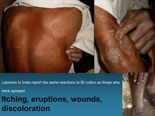 Laborers in India report the same reactions to Bt cotton as those who
were sprayed
Itching, eruptions, wounds,
discoloration