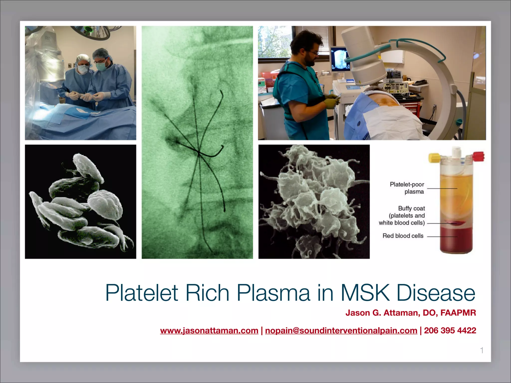 Jason G. Attaman, DO, FAAPMR Presents: Image Guided Platelet Rich ...