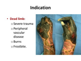 Indication
• Dead limb:
o Severe trauma
o Peripheral
vascular
disease
o Burns
o Frostbite.
 
