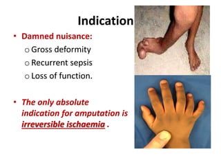 Indication…
• Damned nuisance:
o Gross deformity
o Recurrent sepsis
o Loss of function.
• The only absolute
indication for amputation is
irreversible ischaemia .
 