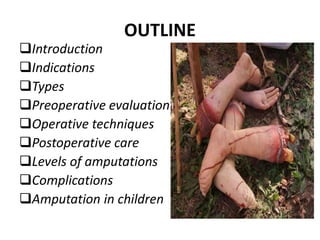 OUTLINE
Introduction
Indications
Types
Preoperative evaluation
Operative techniques
Postoperative care
Levels of amputations
Complications
Amputation in children
 