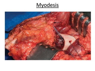 Myodesis
 