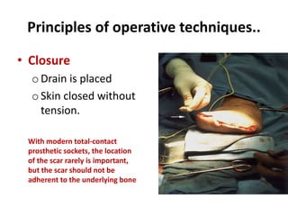 Principles of operative techniques..
• Closure
o Drain is placed
o Skin closed without
tension.
With modern total-contact
prosthetic sockets, the location
of the scar rarely is important,
but the scar should not be
adherent to the underlying bone
 