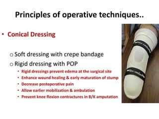 Principles of operative techniques..
• Conical Dressing
o Soft dressing with crepe bandage
o Rigid dressing with POP
• Rigid dressings prevent edema at the surgical site
• Enhance wound healing & early maturation of stump
• Decrease postoperative pain
• Allow earlier mobilization & ambulation
• Prevent knee flexion contractures in B/K amputation
 
