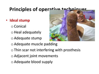 Principles of operative techniques..
• Ideal stump
o Conical
o Heal adequately
o Adequate stump
o Adequate muscle padding
o Thin scar not interfering with prosthesis
o Adjacent joint movements
o Adequate blood supply
 