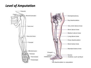 Level of Amputation
 