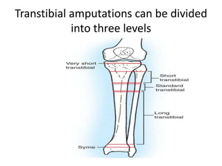 Transtibial amputations can be divided
into three levels
 