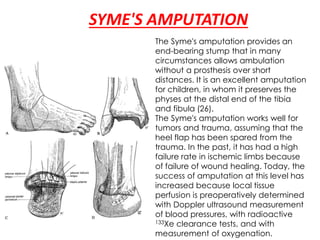 SYME'S AMPUTATION
The Syme's amputation provides an
end-bearing stump that in many
circumstances allows ambulation
without a prosthesis over short
distances. It is an excellent amputation
for children, in whom it preserves the
physes at the distal end of the tibia
and fibula (26).
The Syme's amputation works well for
tumors and trauma, assuming that the
heel flap has been spared from the
trauma. In the past, it has had a high
failure rate in ischemic limbs because
of failure of wound healing. Today, the
success of amputation at this level has
increased because local tissue
perfusion is preoperatively determined
with Doppler ultrasound measurement
of blood pressures, with radioactive
133Xe clearance tests, and with
measurement of oxygenation.
 