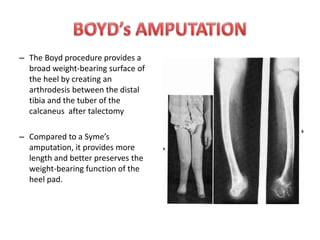 – The Boyd procedure provides a
broad weight-bearing surface of
the heel by creating an
arthrodesis between the distal
tibia and the tuber of the
calcaneus after talectomy
– Compared to a Syme’s
amputation, it provides more
length and better preserves the
weight-bearing function of the
heel pad.
 
