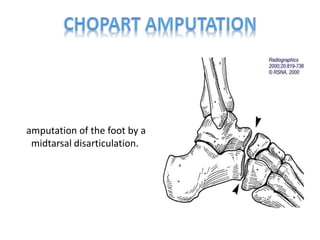 amputation of the foot by a
midtarsal disarticulation.
 