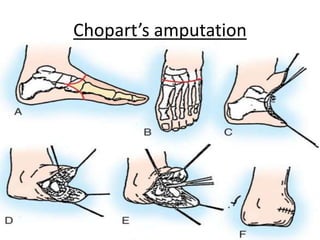 Chopart’s amputation
 