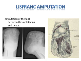 amputation of the foot
between the metatarsus
and tarsus.
 