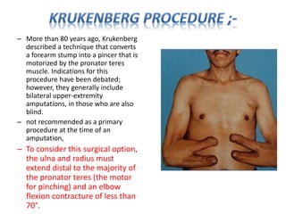 – More than 80 years ago, Krukenberg
described a technique that converts
a forearm stump into a pincer that is
motorized by the pronator teres
muscle. Indications for this
procedure have been debated;
however, they generally include
bilateral upper-extremity
amputations, in those who are also
blind.
– not recommended as a primary
procedure at the time of an
amputation,
– To consider this surgical option,
the ulna and radius must
extend distal to the majority of
the pronator teres (the motor
for pinching) and an elbow
flexion contracture of less than
70°.
 