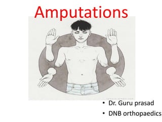 Amputations
• Dr. Guru prasad
• DNB orthopaedics
 