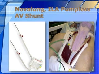 ECCO2R & ECMO | PPTX