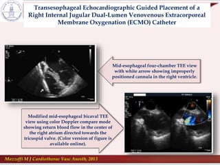Transesophageal Echocardiographic Guided Placement of a
Right Internal Jugular Dual-Lumen Venovenous Extracorporeal
Membrane Oxygenation (ECMO) Catheter
Mazzeffi M J Cardiothorac Vasc Anesth, 2013
Mid-esophageal four-chamber TEE view
with white arrow showing improperly
positioned cannula in the right ventricle.
Modified mid-esophageal bicaval TEE
view using color Doppler compare mode
showing return blood flow in the center of
the right atrium directed towards the
tricuspid valve. (Color version of figure is
available online).
 