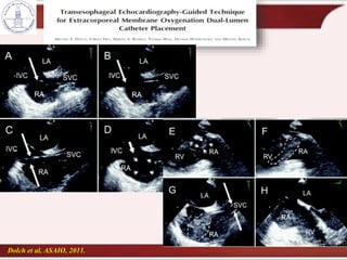 Dolch et al, ASAIO, 2011.
 