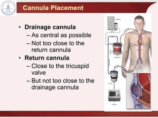 • Drainage cannula
– As central as possible
– Not too close to the
return cannula
• Return cannula
– Close to the tricuspid
valve
– But not too close to the
drainage cannula
 