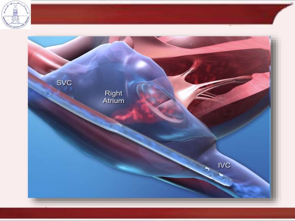 cannulation and recirculation in vv ecmo