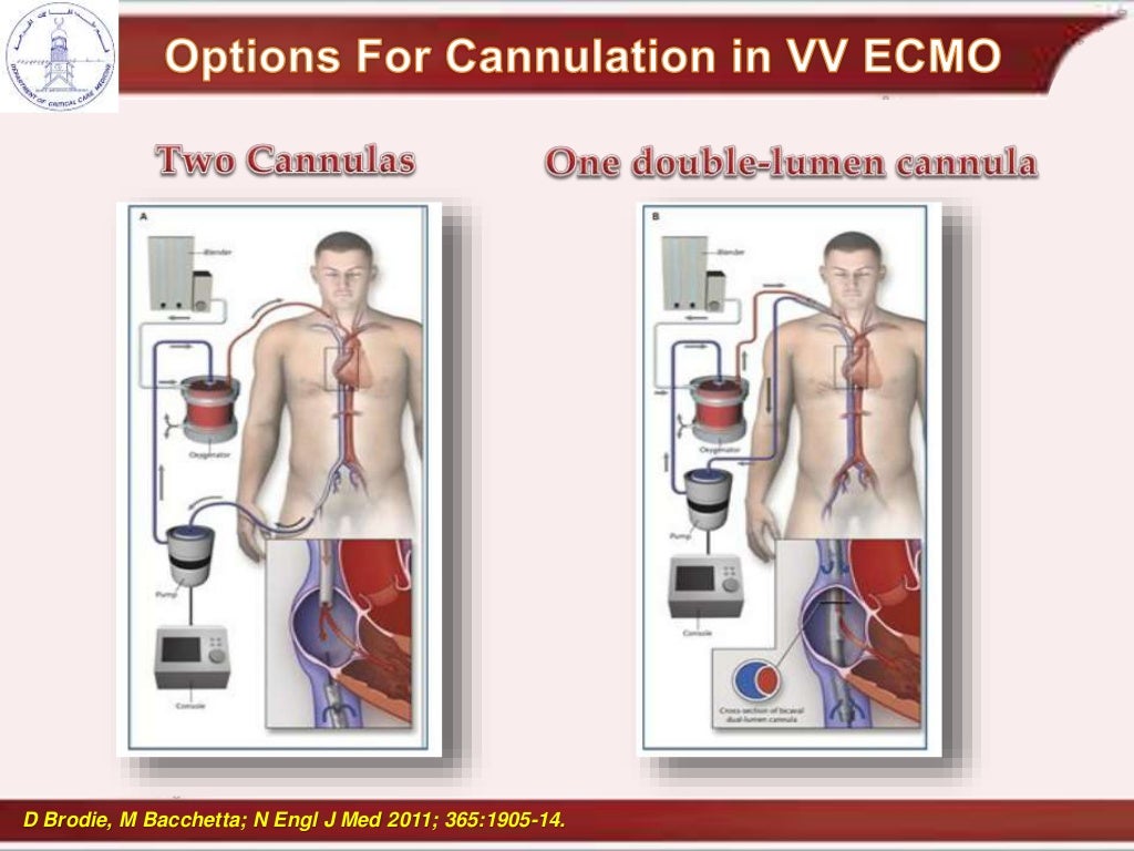 cannulation and recirculation in vv ecmo