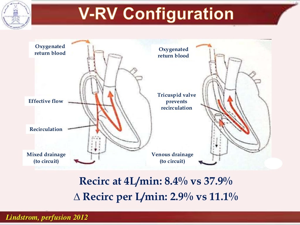 cannulation and recirculation in vv ecmo