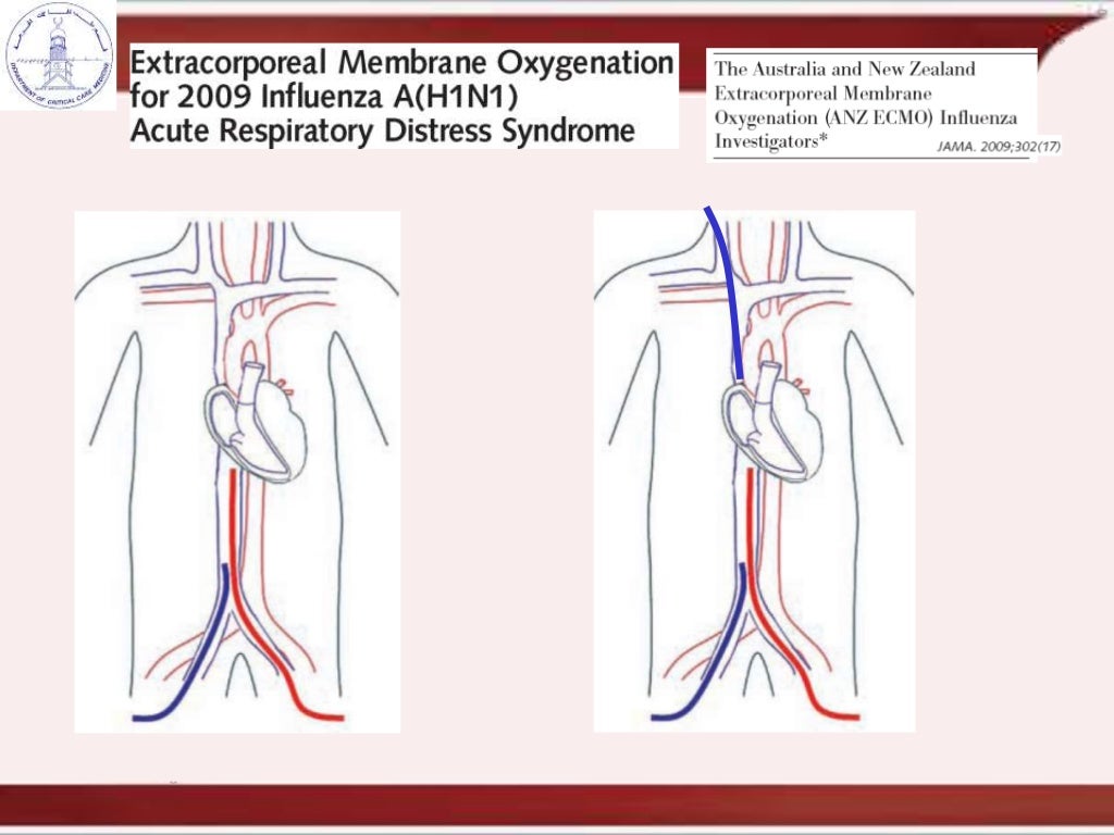 cannulation and recirculation in vv ecmo
