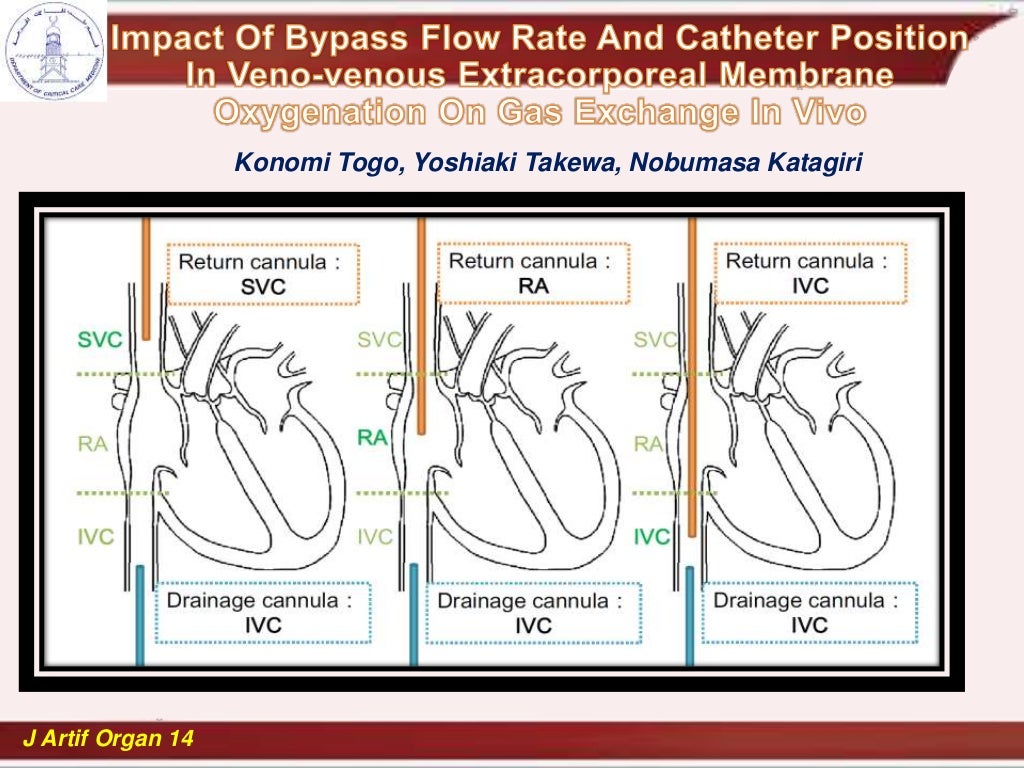 cannulation and recirculation in vv ecmo