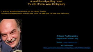 A small thyroid papillary cancer
The role of Shear Wave Elastography
Antonio Pio Masciotra
Campobasso – Molise – Italy
Website www.masciotra.net
YouTube Channel
https://www.youtube.com/channel/UCgCj21nKGAhR997Ia3-QegQ
51 years old asymptomatic woman at her first thyroid US exam.
Two small nodules were found in her left lobe, one in the lower pole, the other near the isthmus.
 