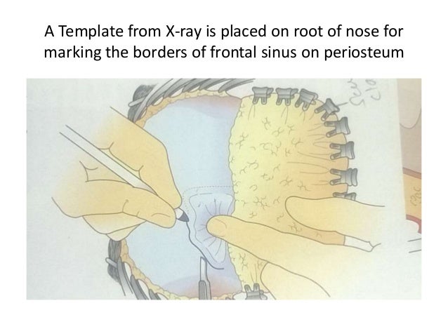 frontal sinus obliteration