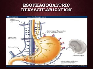 Devascularization management of portal hypertension by Dr.Zarin | PDF