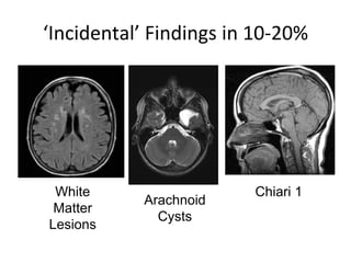 ‘Incidental’ Findings in 10‐20%
White
Matter
Lesions
Arachnoid
Cysts
Chiari 1
 