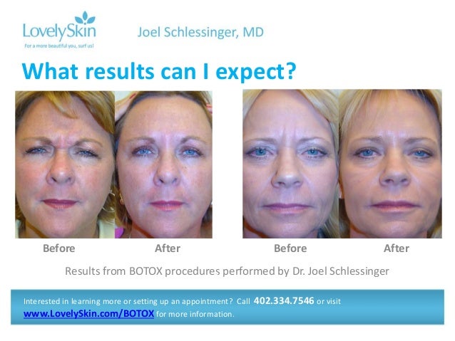 botox schlessinger