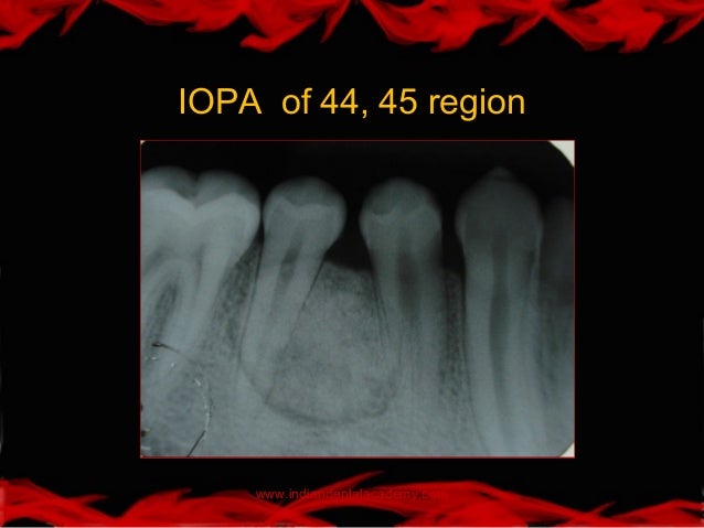 osteoid osteoma of mandible pdf